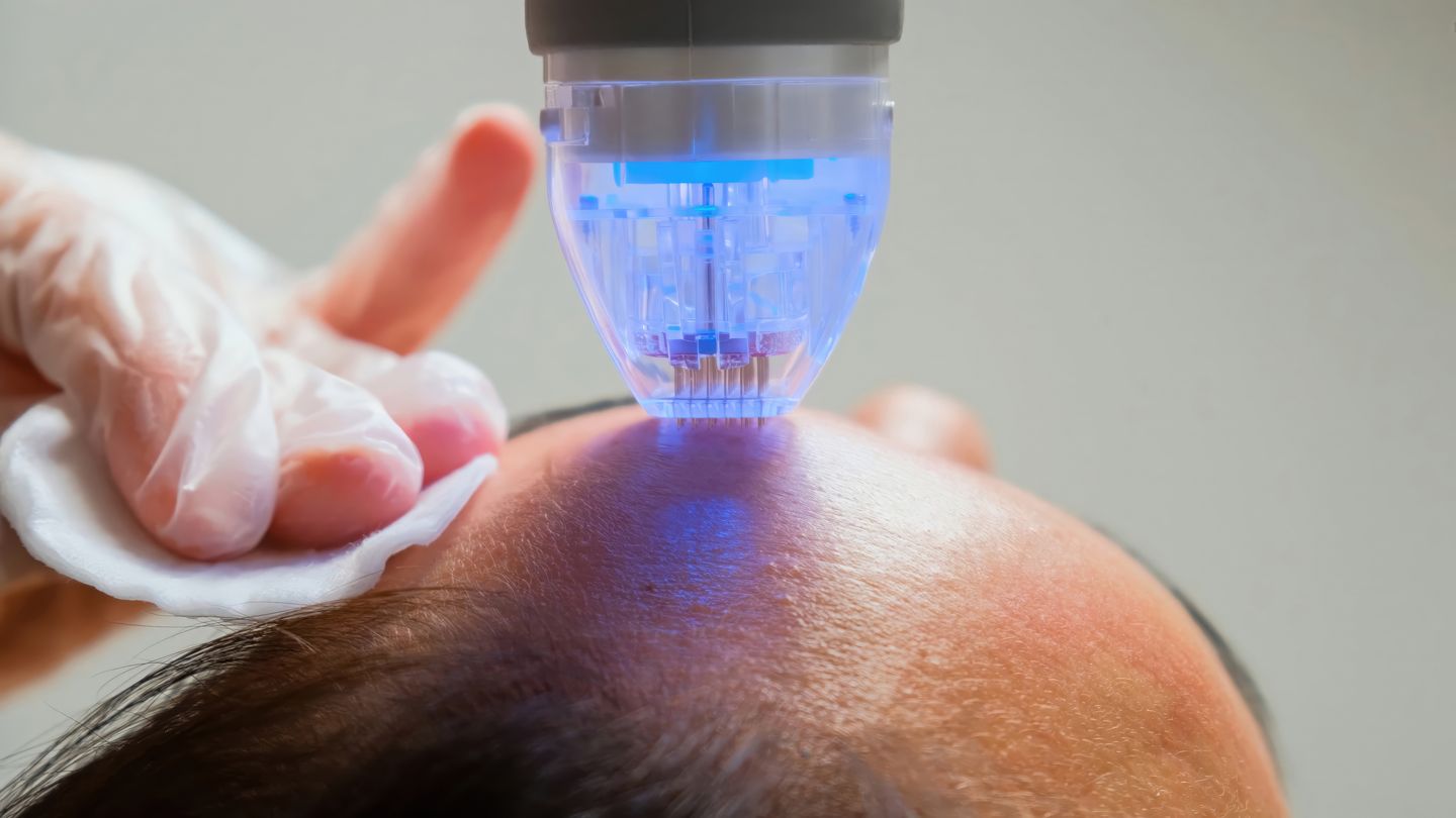 RF microneedling device with fractional needle tip treating a client’s forehead in a beauty clinic